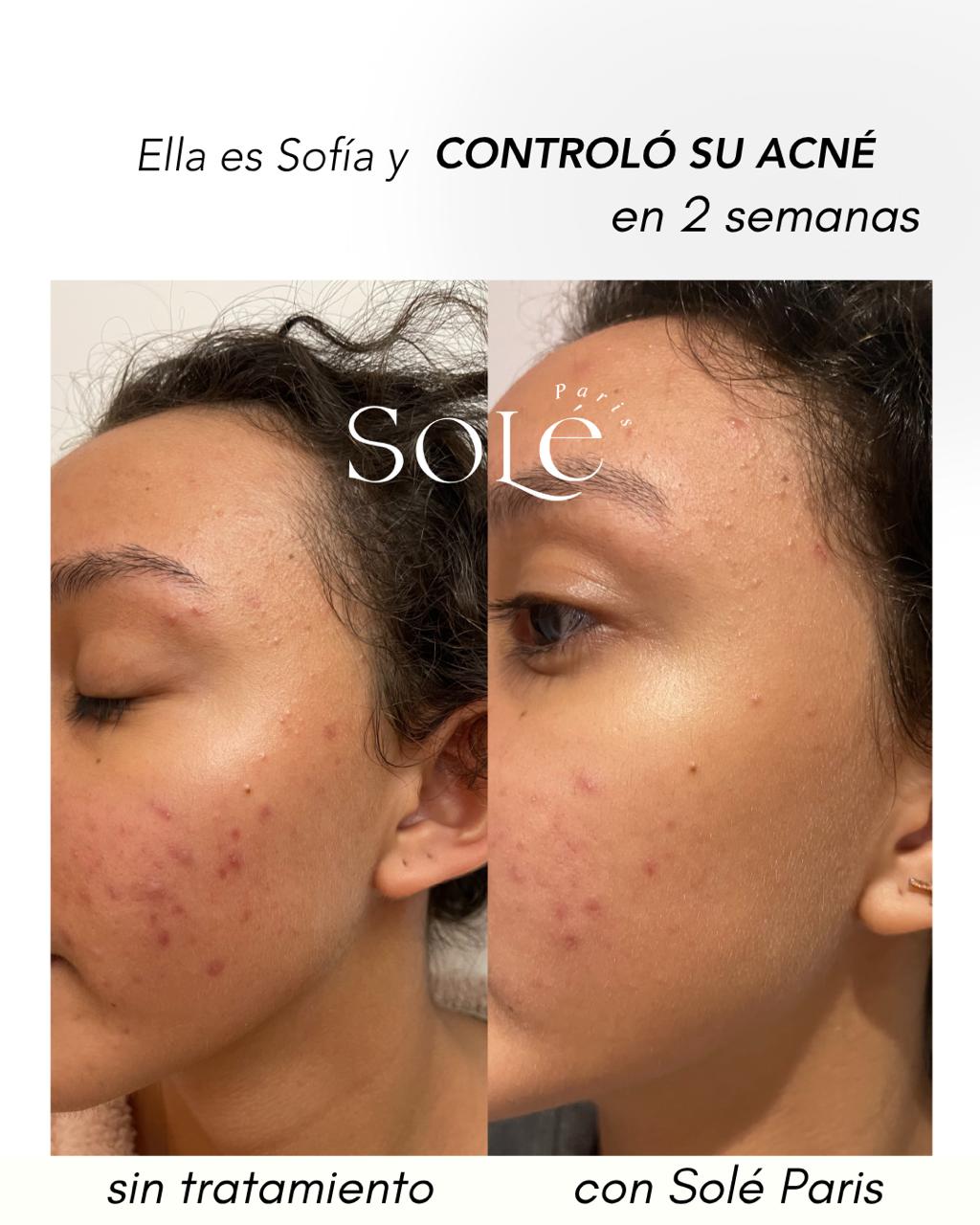 ACNE CONTROL KIT