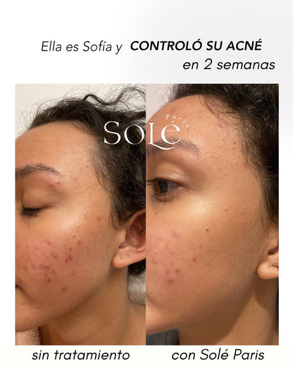 ACNE CONTROL KIT